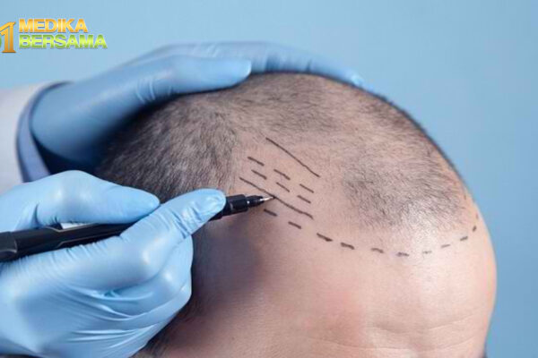 Prosedur Transplantasi Pada Rambut & Risiko yang Dapat Terjadi