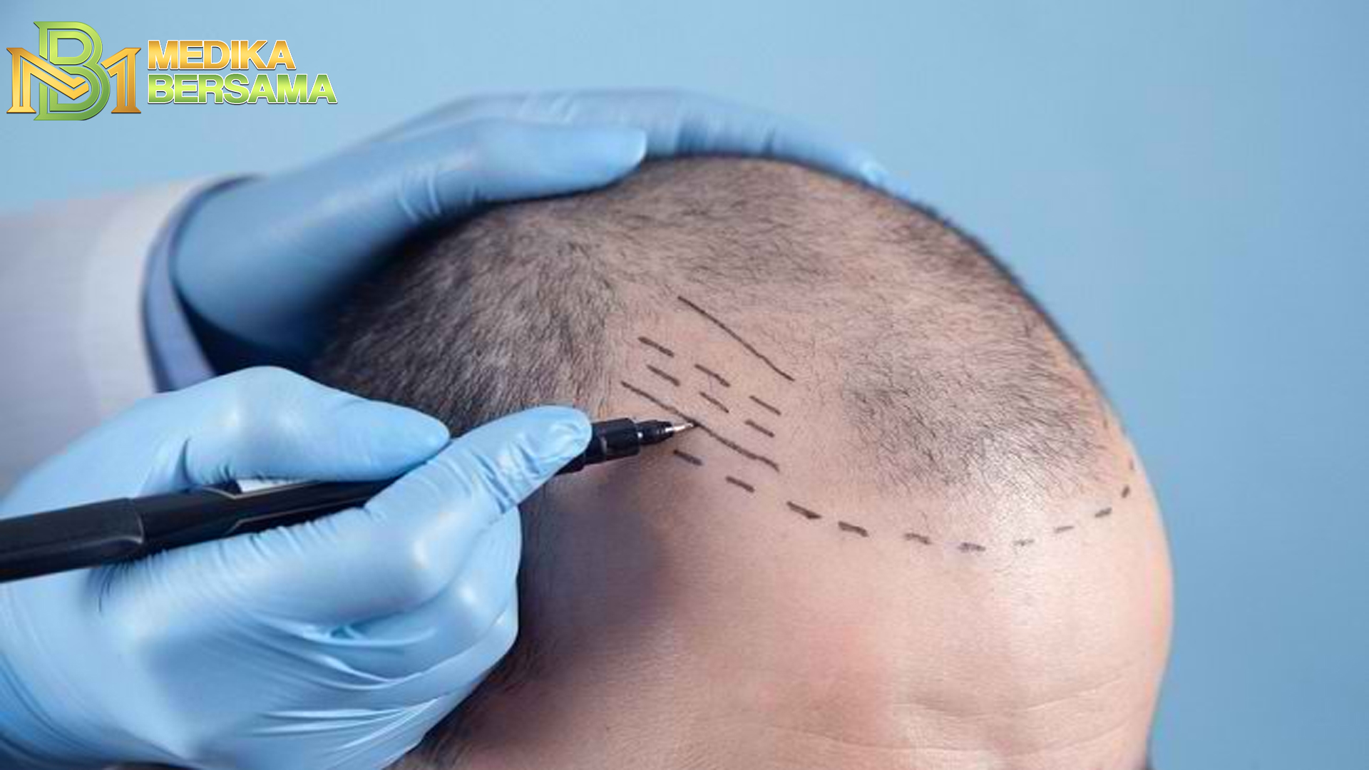 Prosedur Transplantasi Pada Rambut & Risiko yang Dapat Terjadi